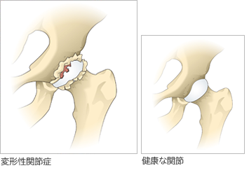 変形性股関節症と健康な関節の比較