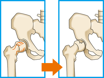 大腿骨頭壊死症と健康な関節の比較