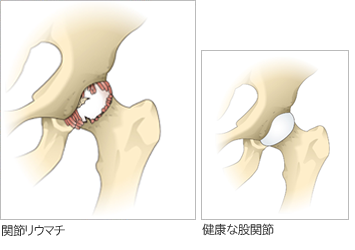 関節リウマチと健康な関節の比較