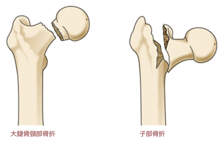 大腿骨転子部骨折のイメージ例