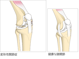 変形性膝関節症と健康な膝関節の比較