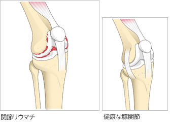 関節リウマチと健康な膝関節の比較