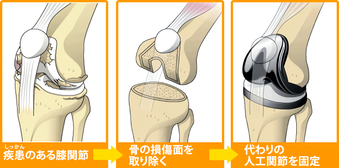 人工膝関節全置換術 手順解説