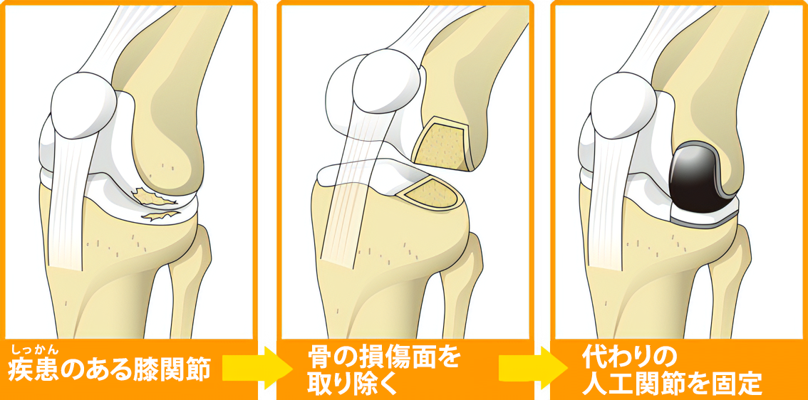 人工膝関節単顆置換術 手順解説